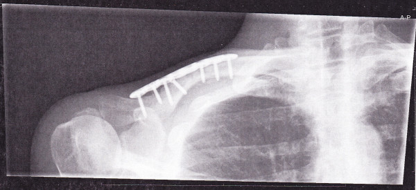 clavicle.jpg